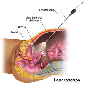 laparoscopic surgery in vijayawada