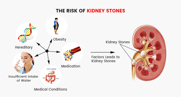 the risk of kidney stones