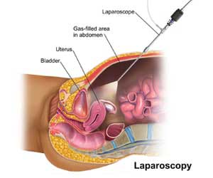 Laparoscopy surgery in vijayawada
