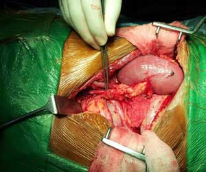 kidney open surgery in vijayawada